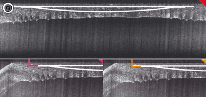 Scan OCT montrant le lenticule planifié, les incisions et les tunnels de guidage - Laser Femto LDV Z8 - Ziemer