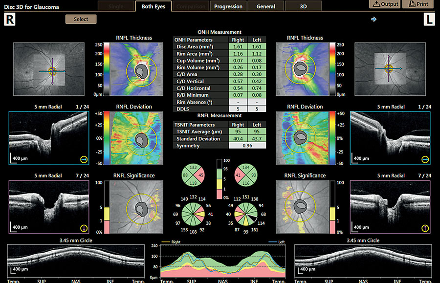 Rapport nerf optique et GCC - XEPHILIO OCT-A1 - Canon