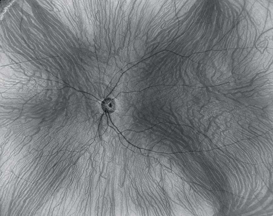 Imagerie En-Face grand champ des veines vortiqueuses de la choroïde - Xephilio OCT-S1 - Canon